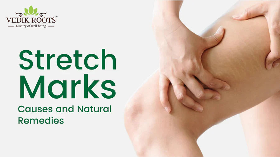 Get rid of stretch marks Naturally